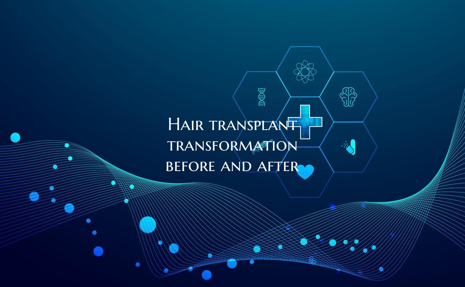 Hair transplant transformation before and after